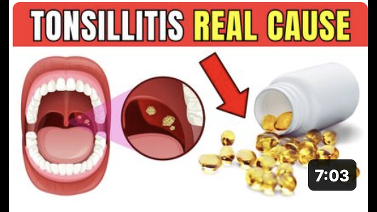 This is the REAL CAUSE of your recurring TONSILLITIS - it's not what you think!