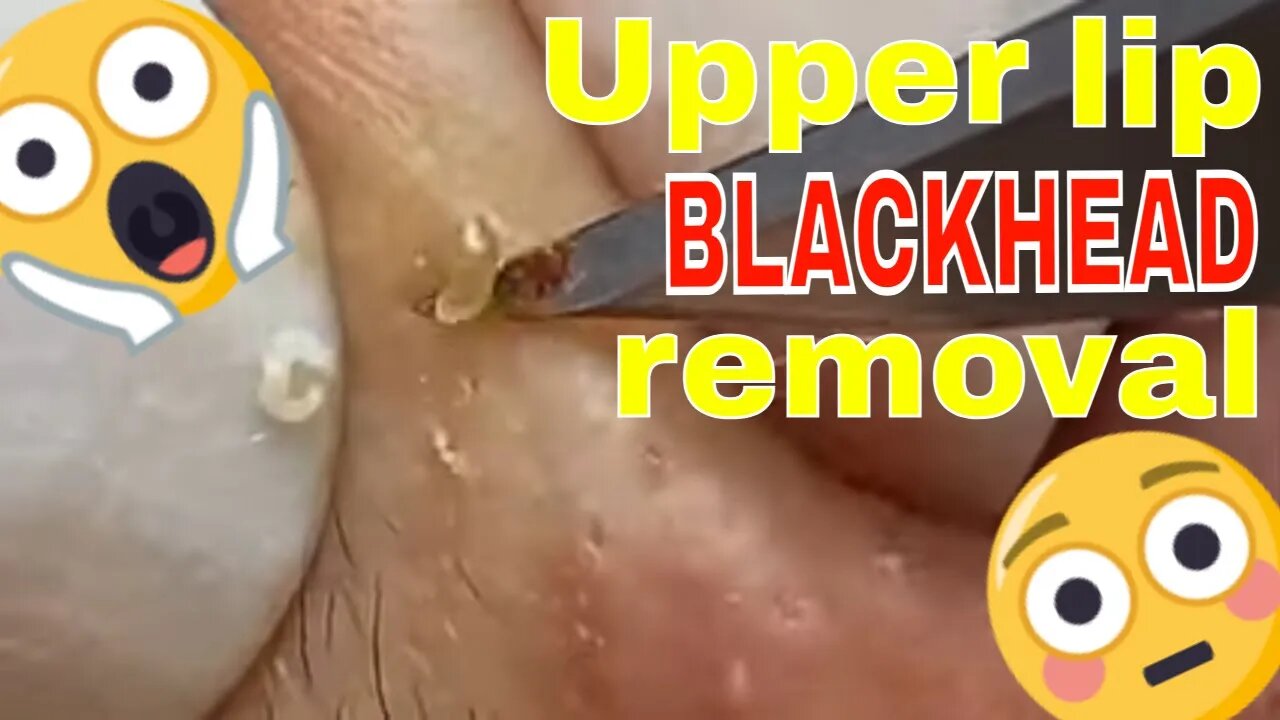 Upper lip blackhead removal 👄🪱 #blackheadremoval #blackhead #blackheads #blackheadheadsextraction