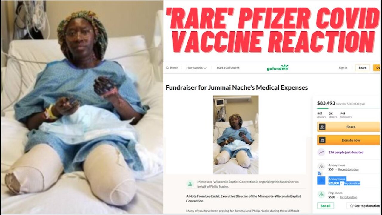 Minnesota Woman Loses Both Legs & Hands After PFIZER COVID VACCINE!