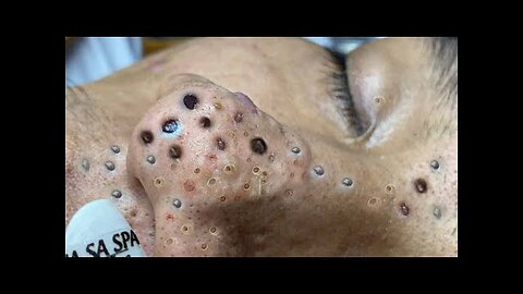 Satisfying blackhead removal, relaxing Pimple Popper 224