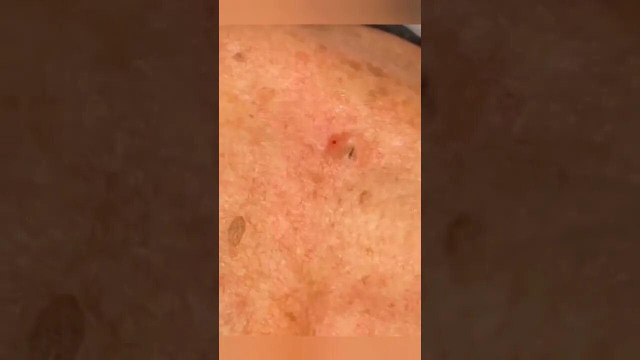 Remoção de Cravos e Espinhas - Remove Squeezing Blackheads and Pimples - Just Relax | Apenas Relaxe