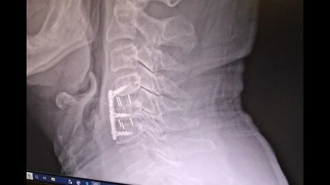 19 ACDF Recovery 6 Week checkup