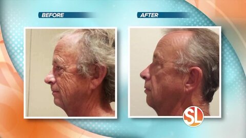 Coolpeel is the latest in technology to improve skin texture with little downtime and big results