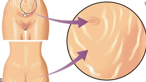 피부재생 튼살치료원리 팽창선조 치료 자향미한의원 St침