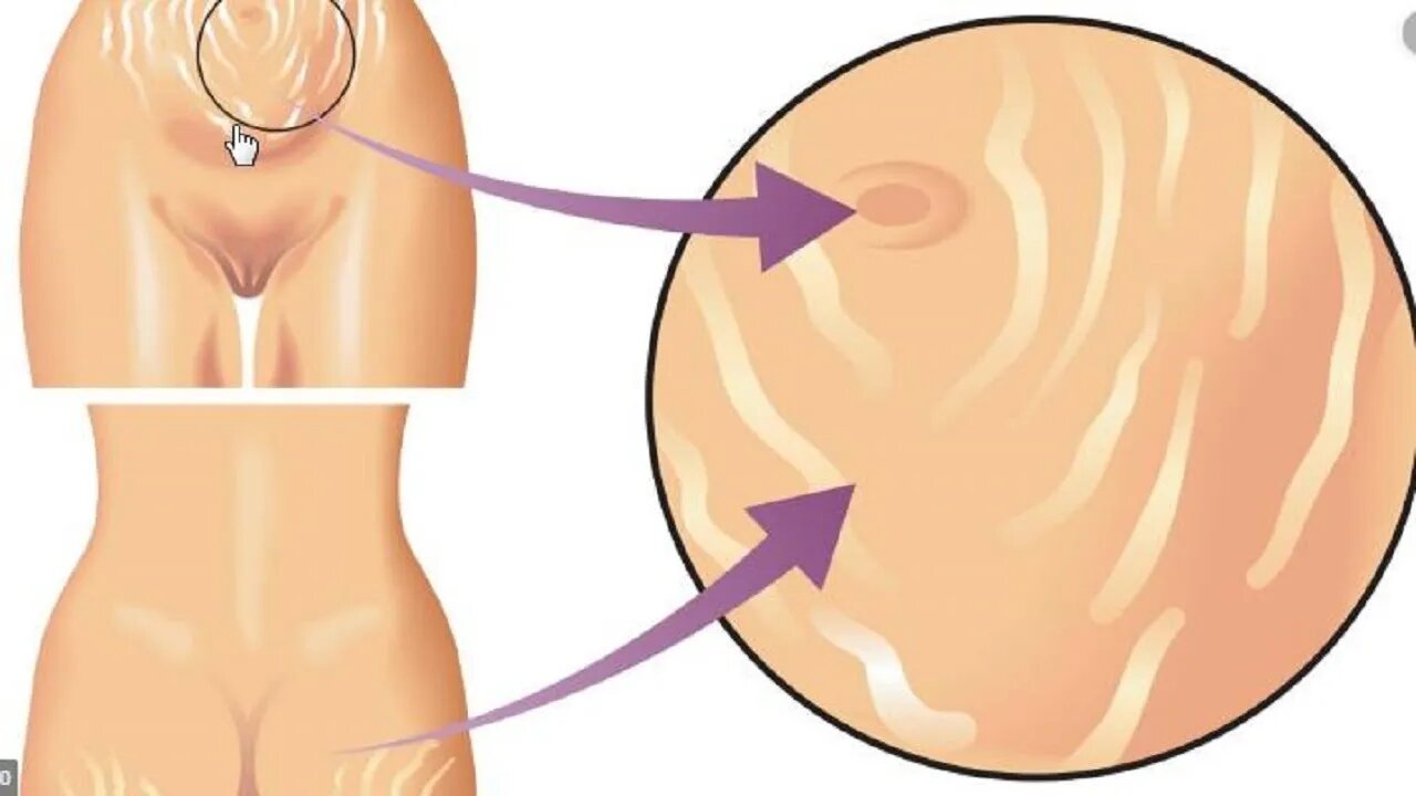 피부재생 튼살치료원리 팽창선조 치료 자향미한의원 St침