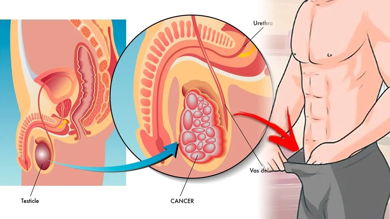 Eat These 7 Foods to Help Prevent Prostate Cancer