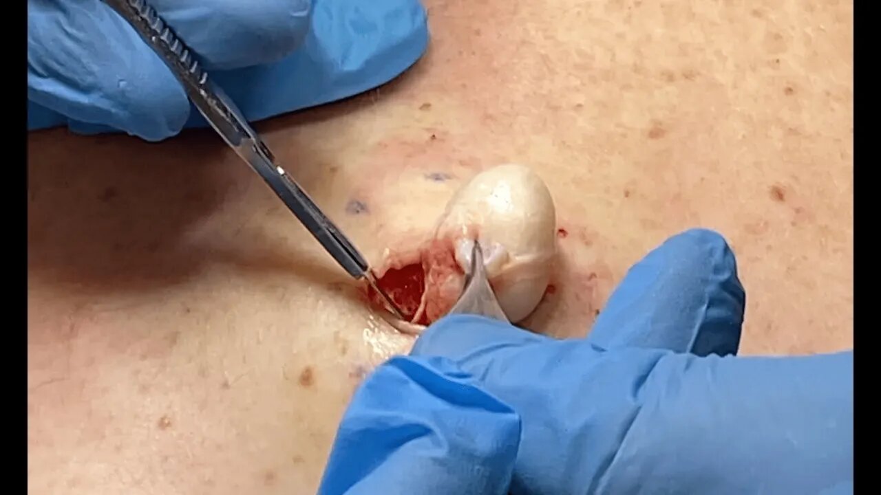 Removal of Epidermal cyst on the mid back with some associated scarring