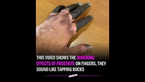 Shocking Effects of Frostbite on Fingers