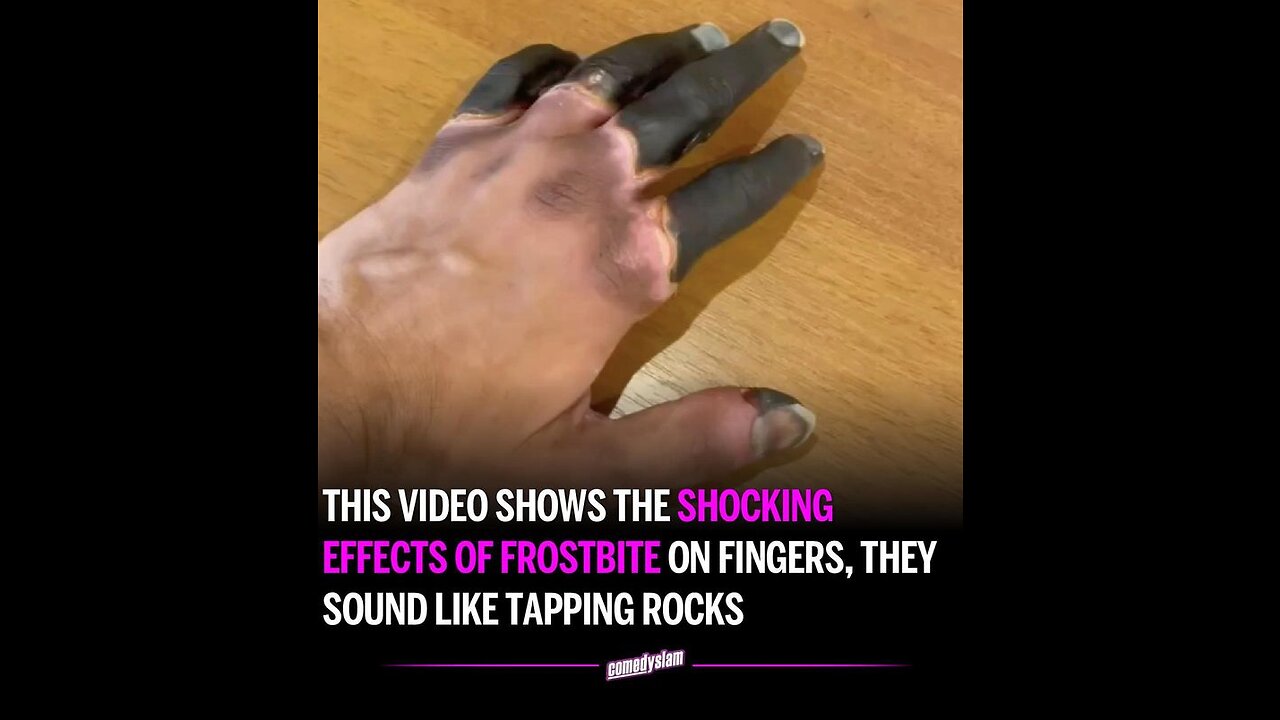 Shocking Effects of Frostbite on Fingers