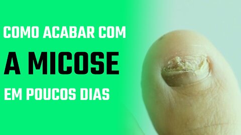 Como Acabar com a Micose em Poucos Dias