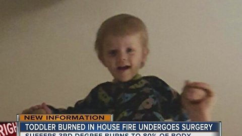 Toddler Burned In House Fire Undergoes Surgery