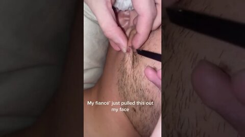 Enormous Ingrown Hair Removal