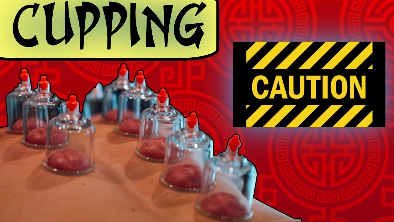 Cupping - Warning! - The Other Acupuncture...