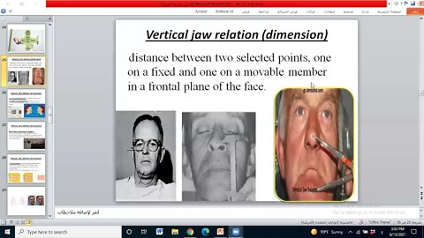 Prosthodontics L14 part2 (Maxillomandibular Relations)