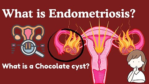 Endometriosis and Chocolate Cysts Explained Easy