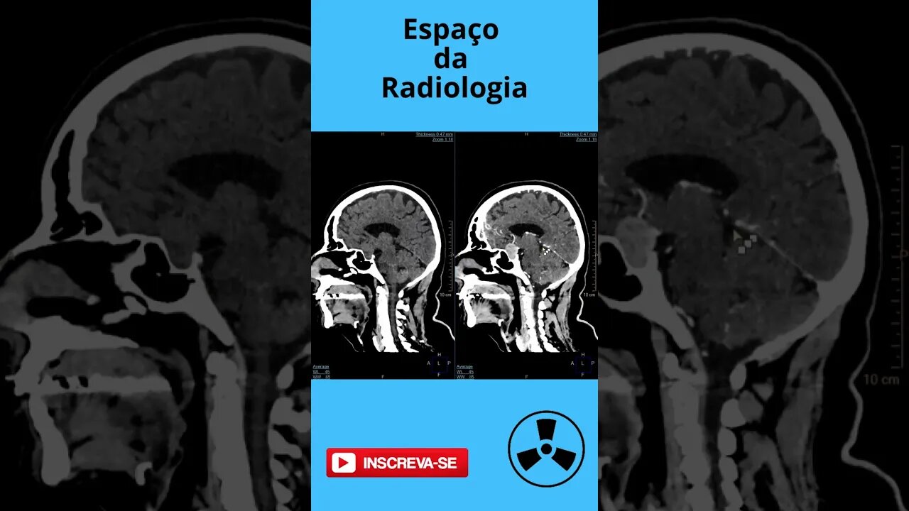 Tumor na hipófise mostrado na tomografia. #shorts