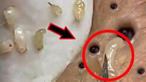 Amazing Facial Blackheads Popping - PIMPLE POPPER | blackheads removal