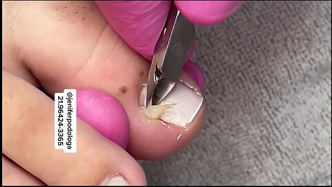 Unha encravada, retirada com sucesso!!! #unhaencravada #podologia #nails #ingrown_toenail