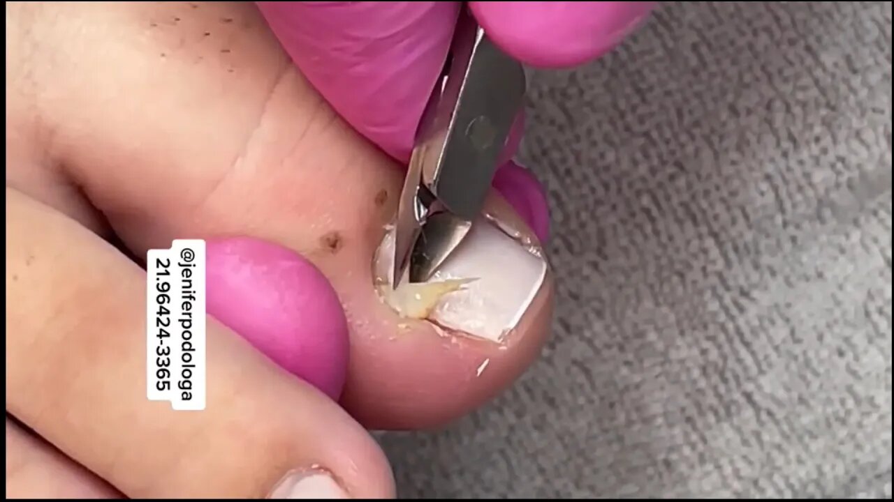 Unha encravada, retirada com sucesso!!! #unhaencravada #podologia #nails #ingrown_toenail
