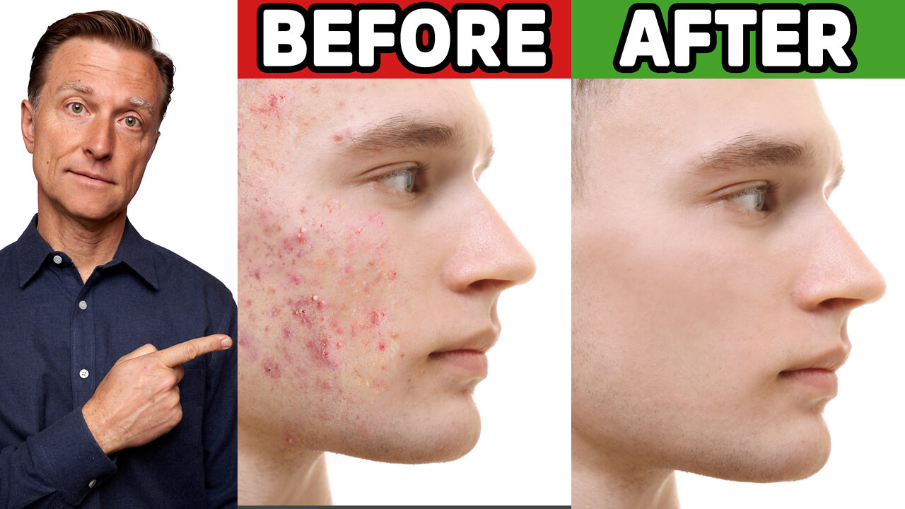 The Best Trick for Clear Skin (Acne, Aging, Wrinkles, Liver Spots)