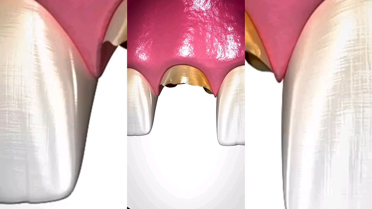 Bone Grafting Explained 🤔