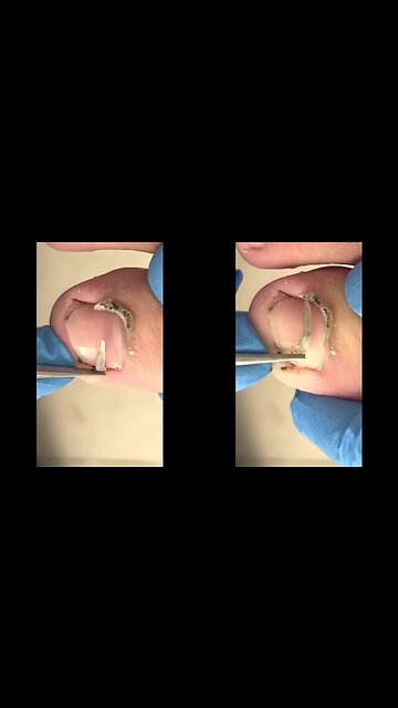Satisfying Toenail ingrown removal