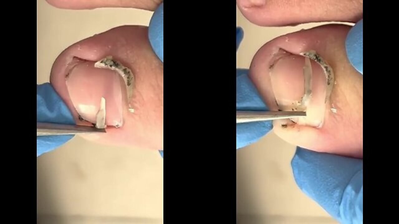 Satisfying Toenail ingrown removal