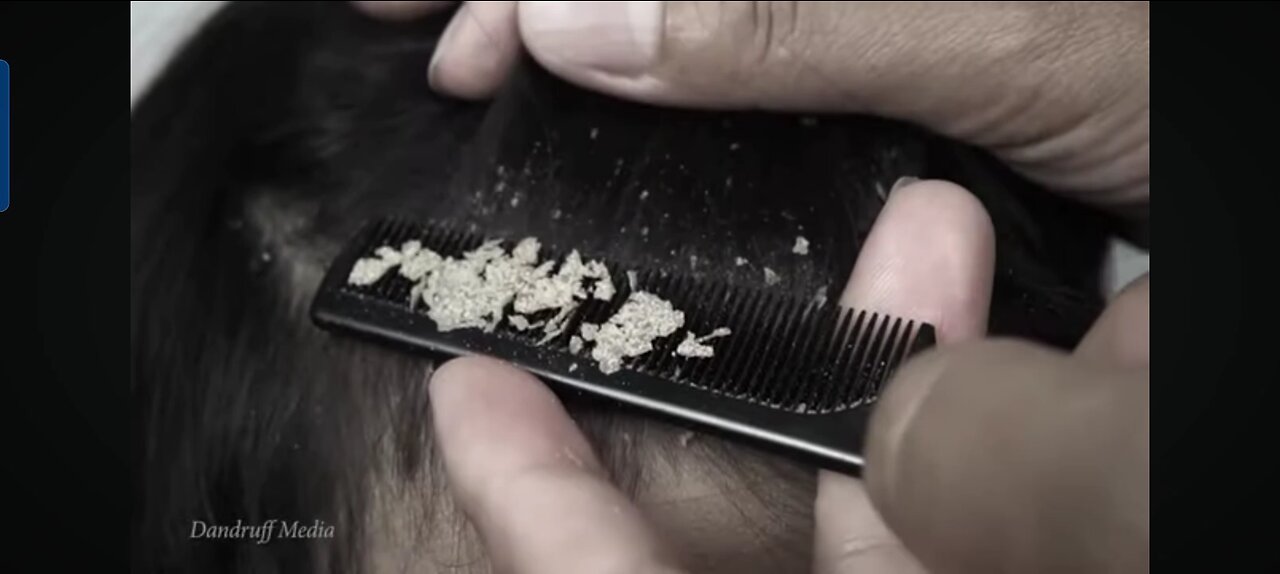 scratching dandruff from hair | White flakes 🤍🤍