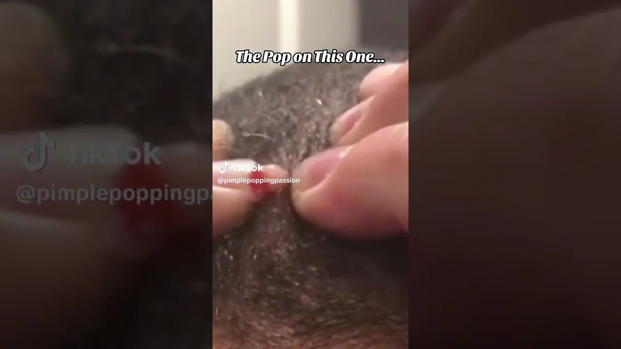 THE POP ON THIS ONE!!! #pimplepoppingvideos #pimplepopping #pimplesremoval #pimpleproblem