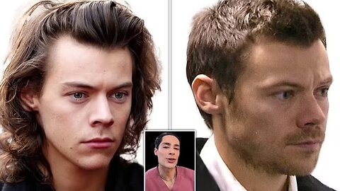 Harry Styles Hair Transplant Rumors Spark Debate