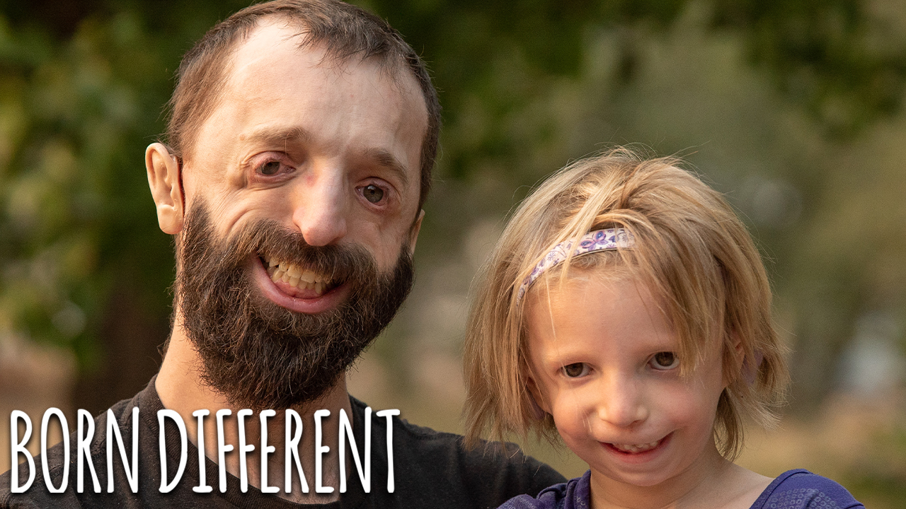 Father And Daughter Battle Rare Facial Condition | BORN DIFFERENT