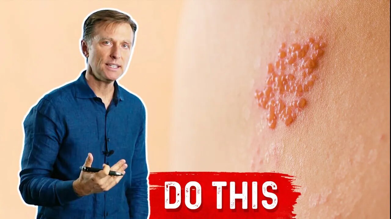 How to Deal With Ringworm Naturally