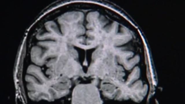 Report: More Nevadans suffer from Alzheimer's disease