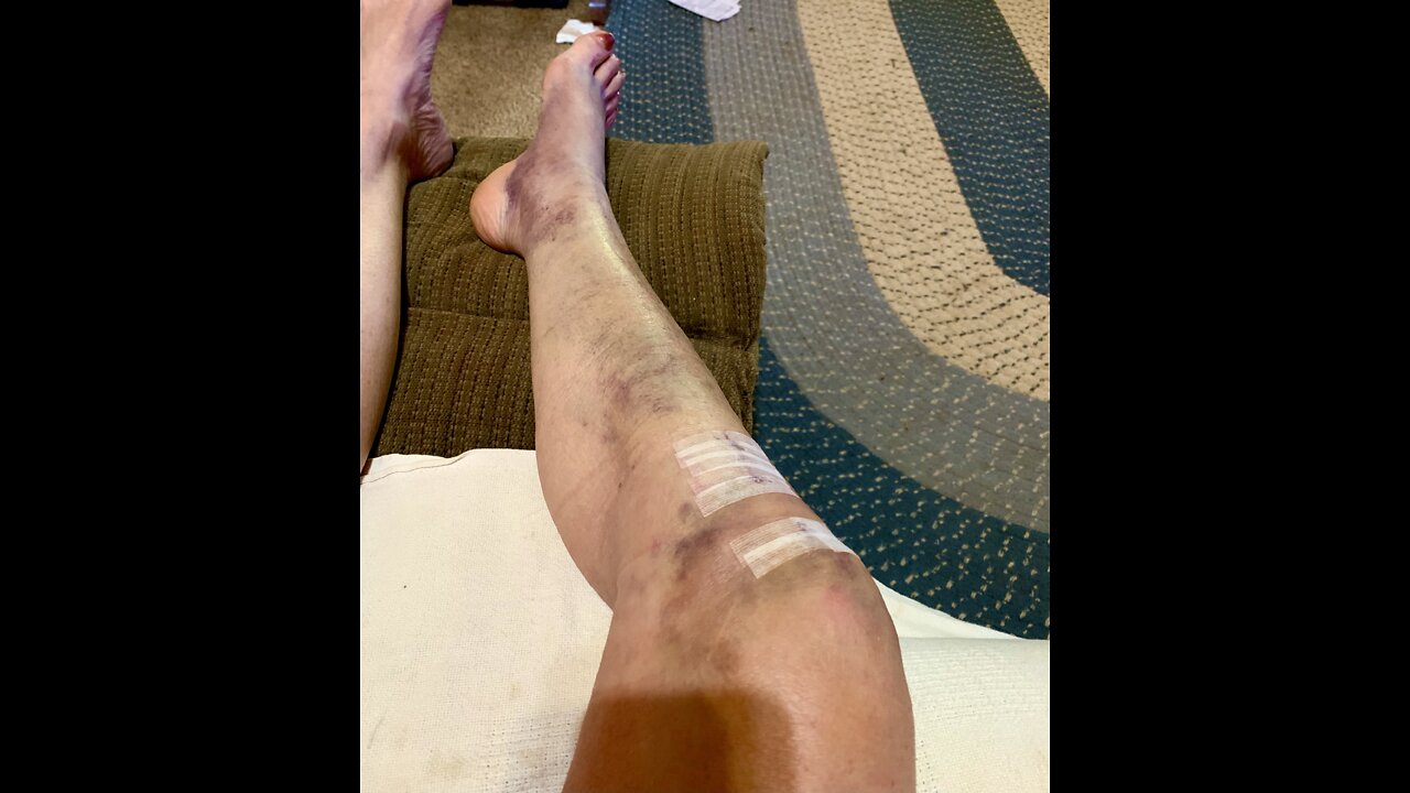 Bruising and swelling three days after knee surgery