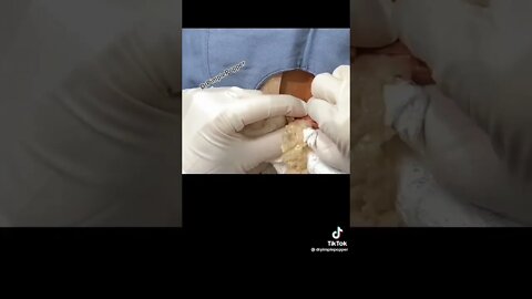 DrpimplePopper😱 #shorts #fyp #foryou #tiktok #skincare