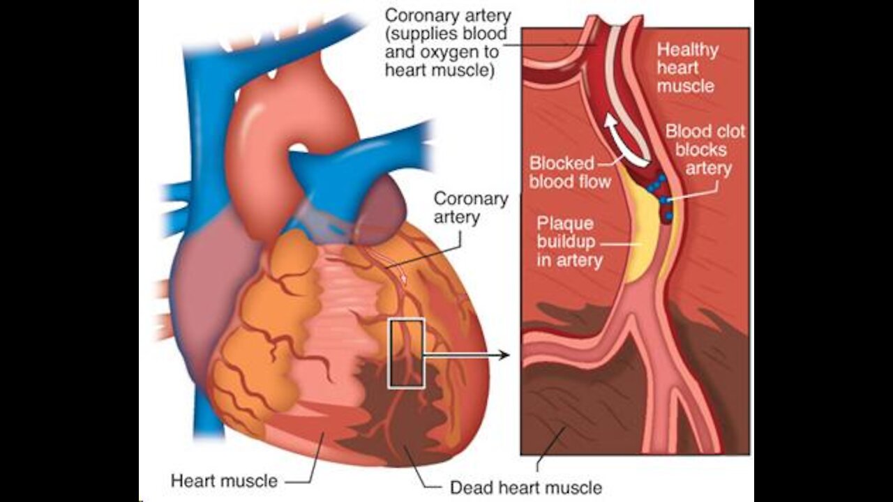 Worldwide Pandemic Of N-STEMI Heart Attacks Caused By Blood Clots