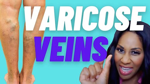 What Causes Varicose Veins? What Are the Treatments for Varicose Veins? A Doctor Explains