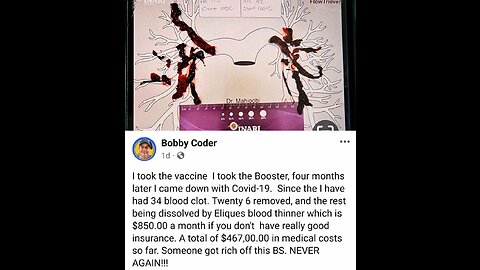 ⚠️Vaccinated & boosted. 34 blood clots.