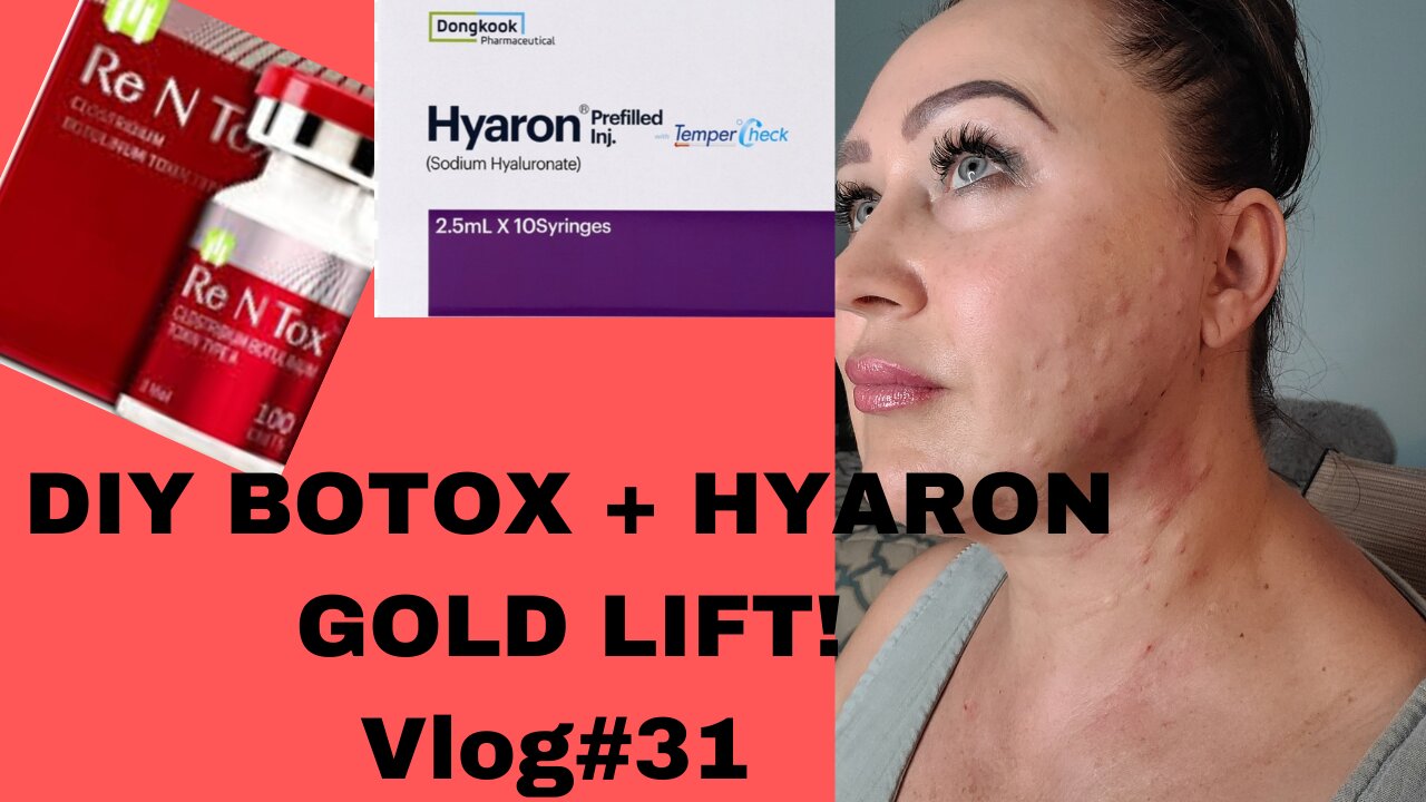 BOTOX+ HYARON GOLDEN LIFT! NEW TECHNIQUES #BOTOX #HYARON #MESOTHERAPY THREADS BONUS VLOG#31 5.27