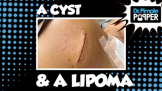 When a Cyst and Lipoma make Friends