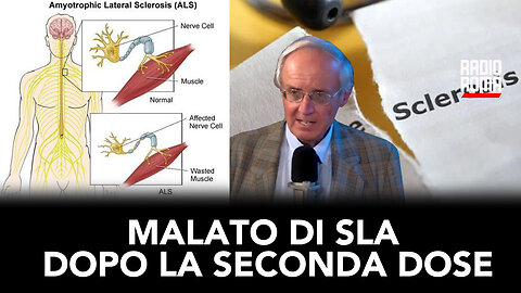 MALATO DI SLA DOPO LA SECONDA DOSE (con Silvio Sposito)