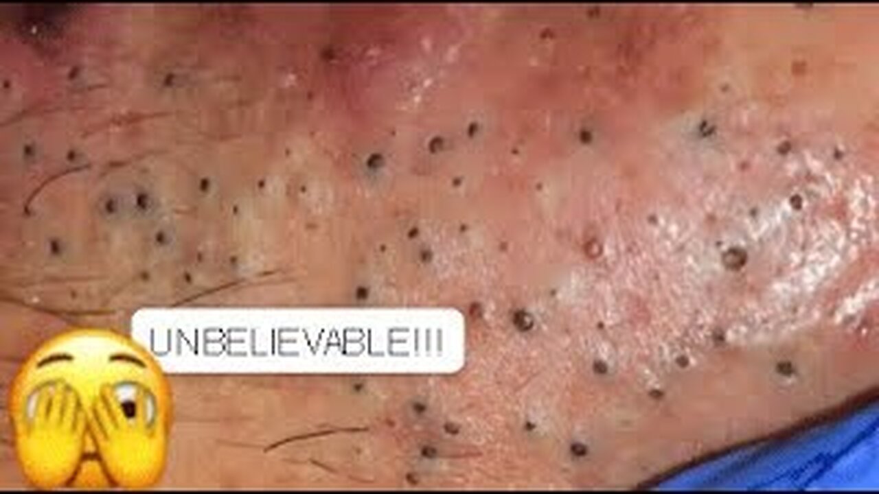 blackheads removing and extraction acne treatment