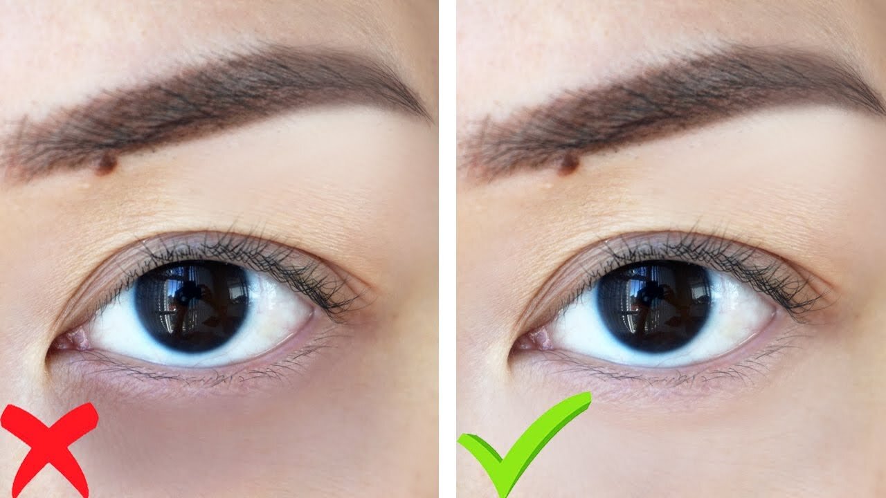 How To: Get Rid of Dark Under Eye Circles FAST!