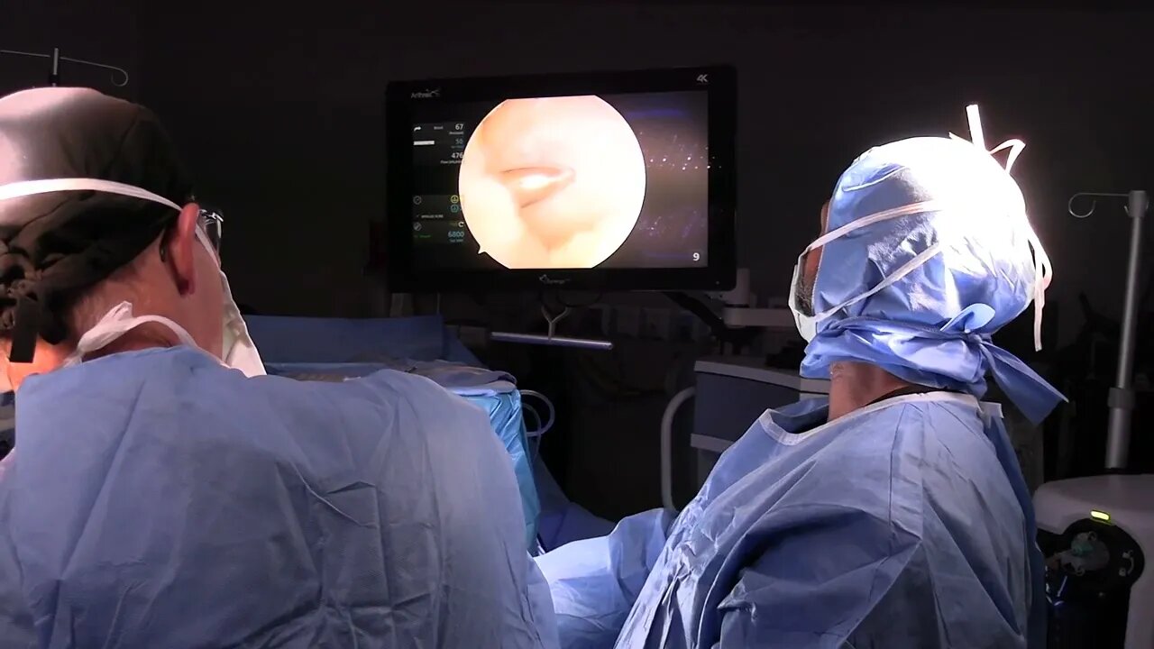 PLICA resection - Barbour Orthopaedics