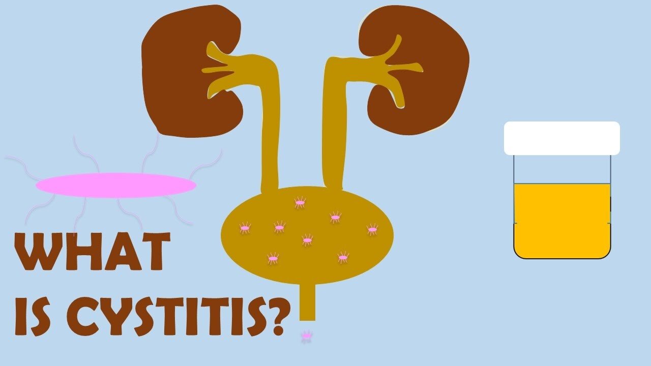 What is Cystitis?