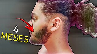 4 MESES USANDO MINOXIDIL