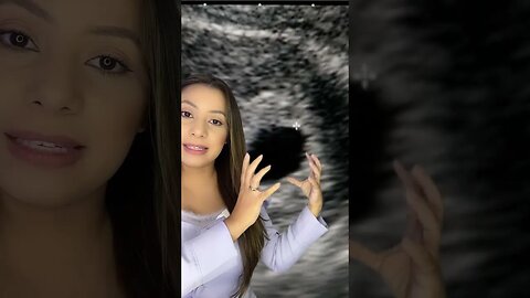 A causa da perda gestacional da Patrícia Moreira