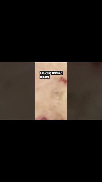 Satisfying Relaxing Blackhead Removal Part 1 #shorts #satisfying #removal #pimplepopping #pimple
