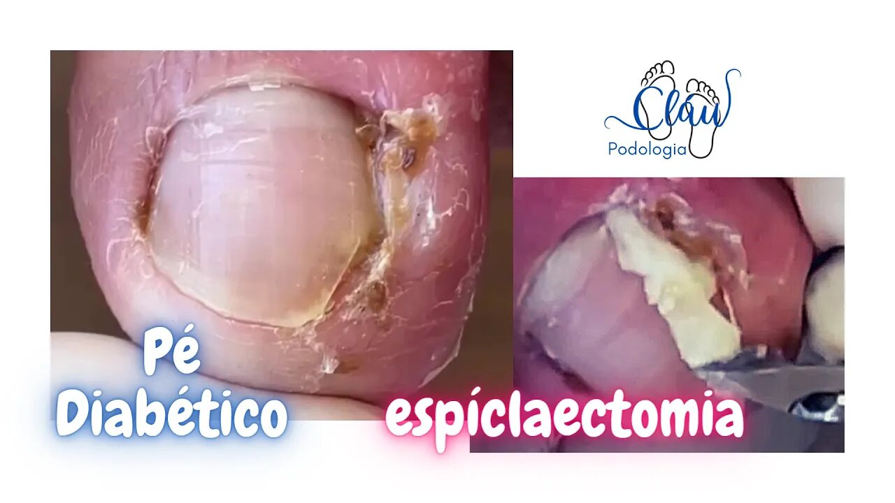 Corte INCORRETO + Pé DIABÉTICO = Unha ENCRAVADA #unhas #pes #dor #podologia #procedimento #diabetes