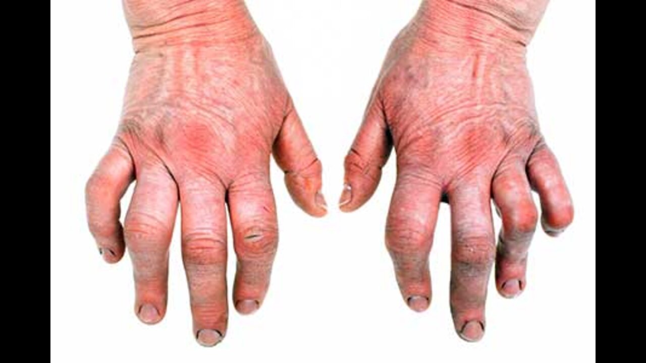 How to Preventing Arthritis. Learn about 5 Ways to Manage Arthritis